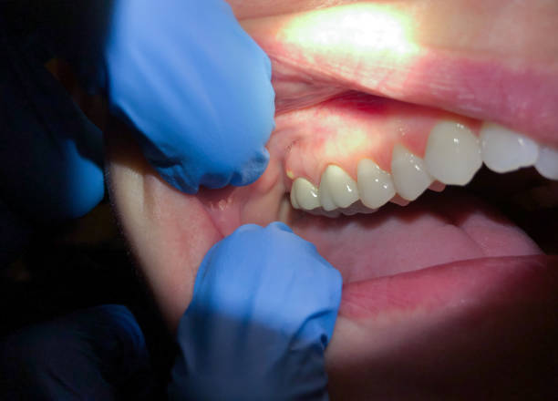 Best Cracked Tooth Emergency Dentist  in Welcome, SC